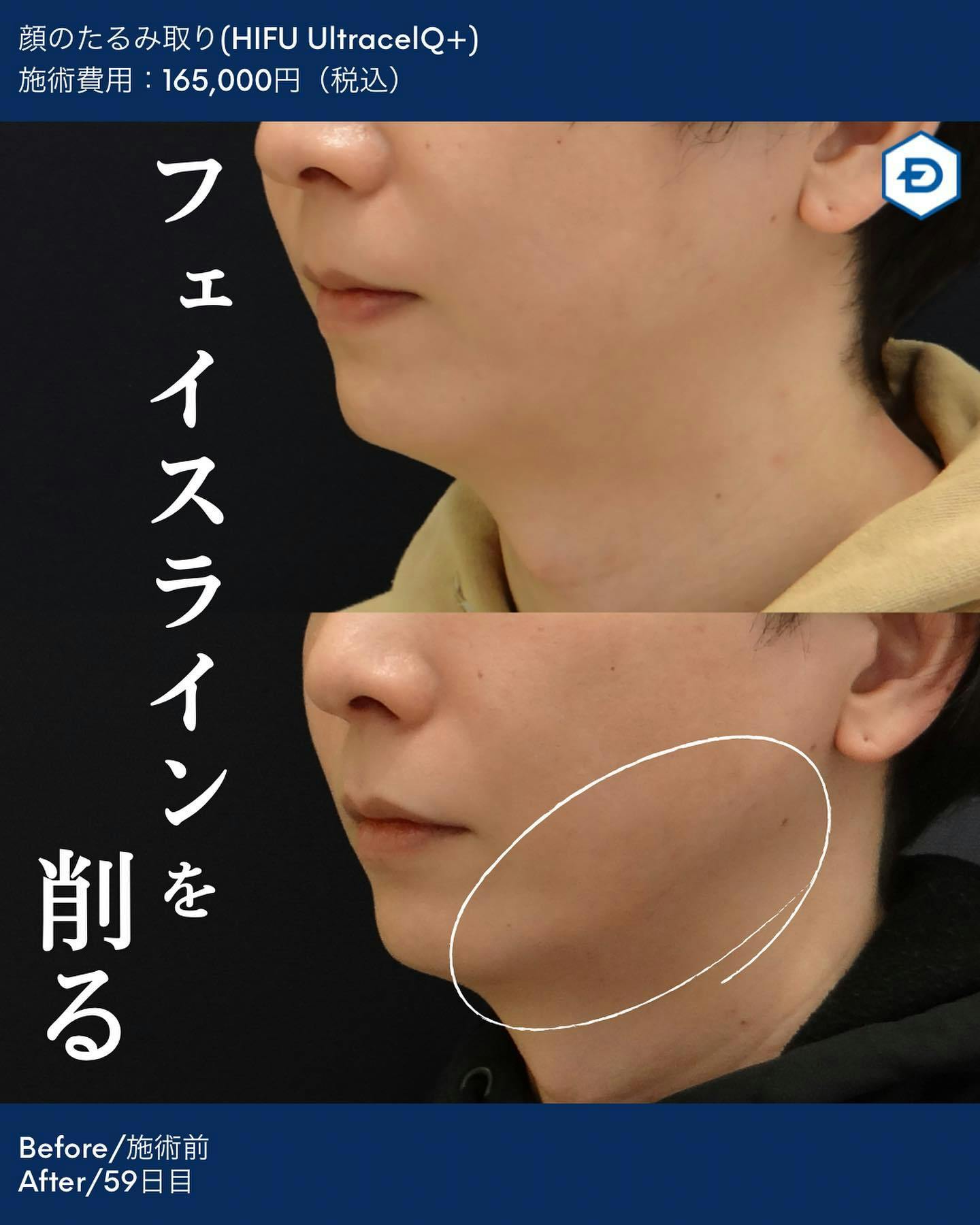 【男性・たるみ】顔のたるみ取り(HIFU UltracelQ+)_before_aftar