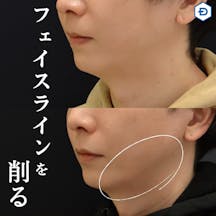 【男性・たるみ】顔のたるみ取り(HIFU UltracelQ+)_before_aftar