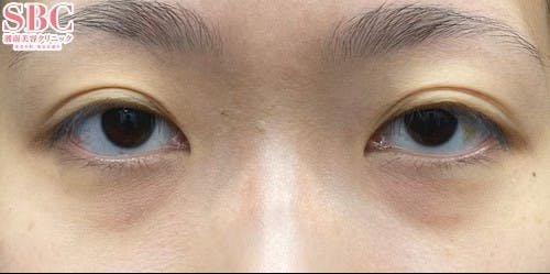 【20代女性・目元】目の下の切らないクマ・たるみ（ふくらみ）取り、ナチュラル脂肪注射コンデンスリッチ、ナチュラル脂肪注射ナノリッチ_before
