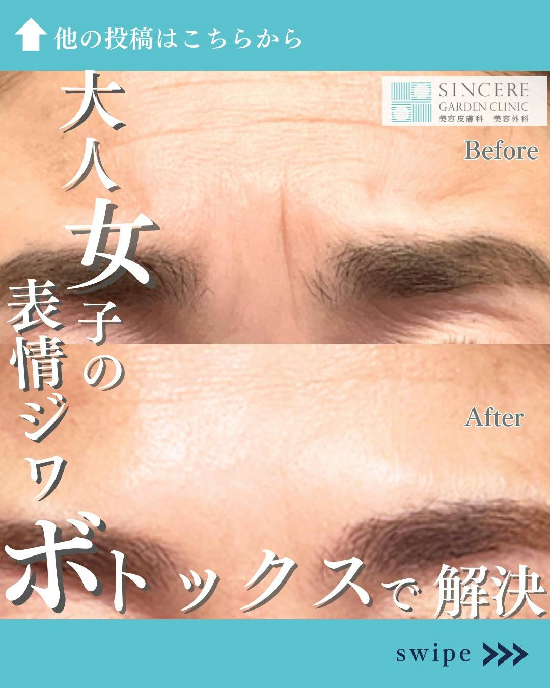【女性・眉間】しわとりボトックス_before_aftar