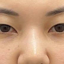 【女性・目元】裏ハムラ法・VOV(ボブ)リフト_after