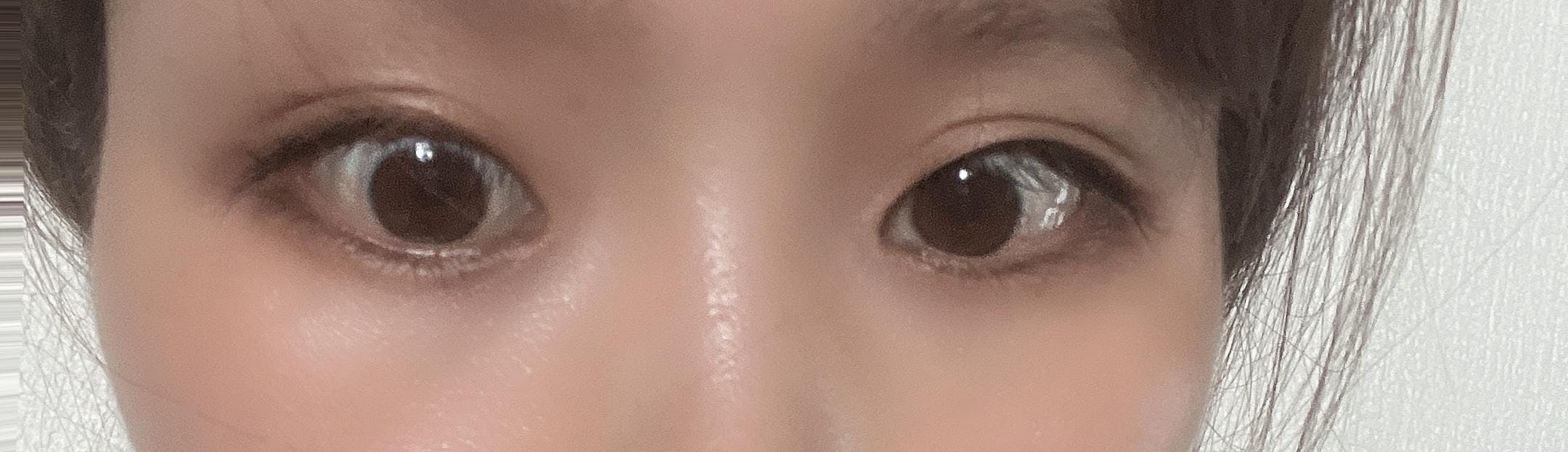 城本クリニック福岡院で外科的涙袋形成を受けたりりさんの写真