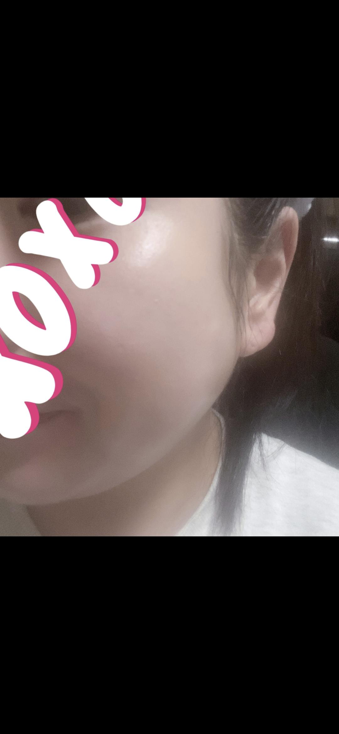 品川スキンクリニック岡山院でを受けたマチルダさんの写真