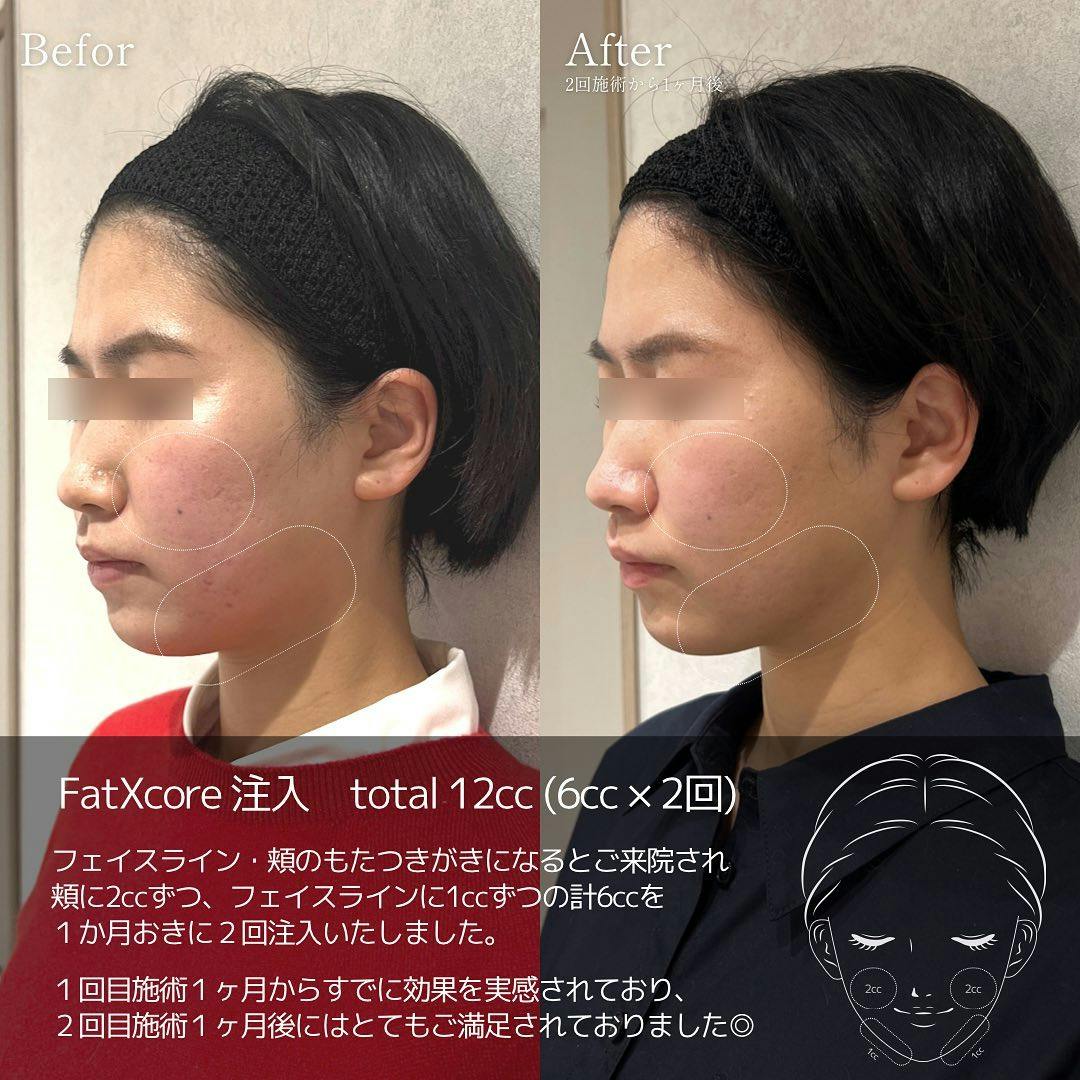 【女性・輪郭】脂肪溶解注射_before_aftar