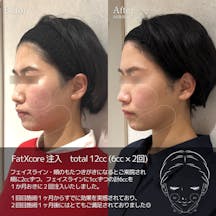 【女性・輪郭】脂肪溶解注射_before_aftar
