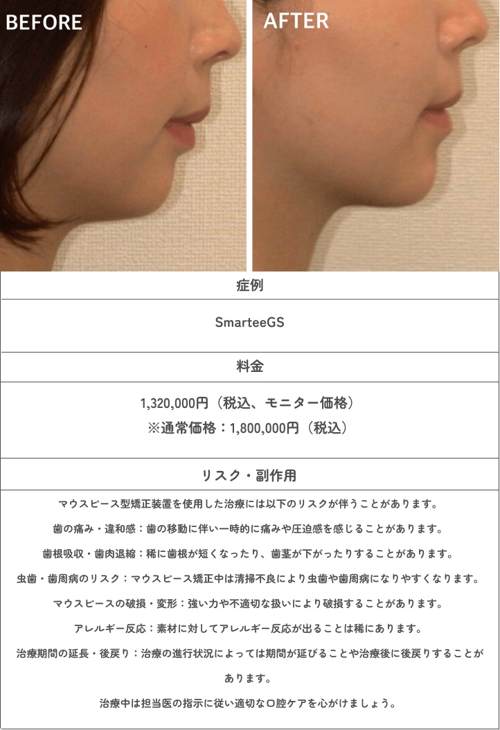 SmarteeGSの症例