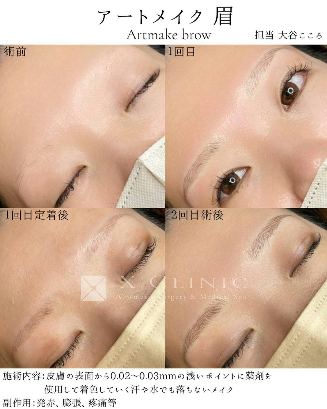 【女性・眉】眉毛アートメイク_before_aftar
