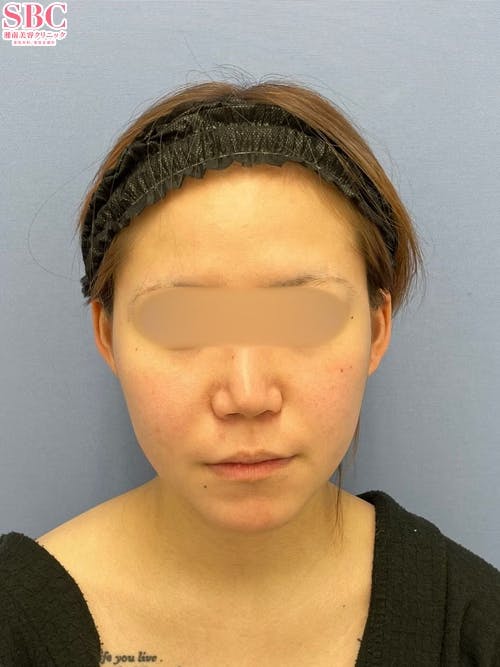 【女性・輪郭】Aquicell（アキーセル）脂肪吸引、根こそぎVASER脂肪吸引、ジョールファット除去術_before