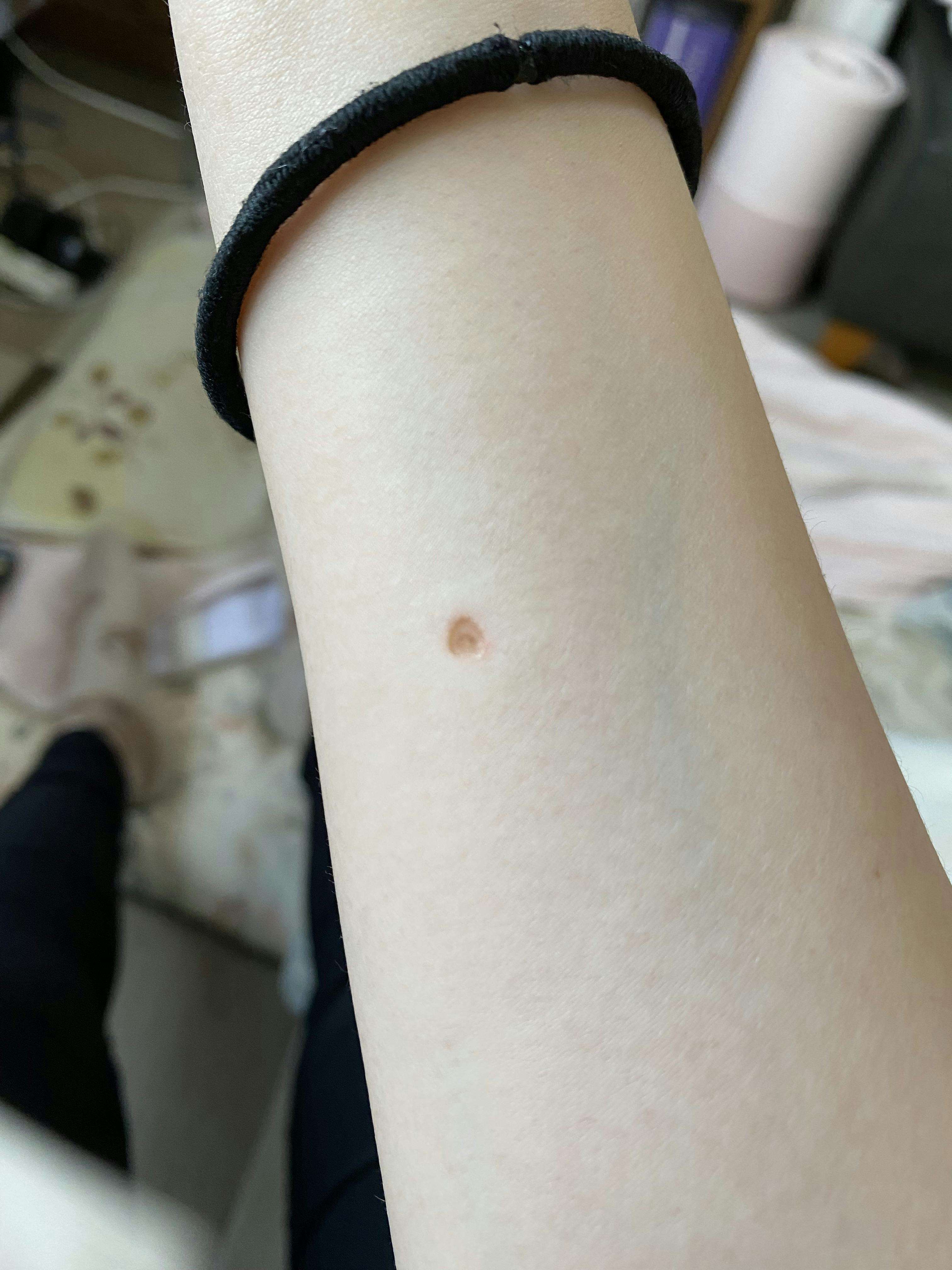 ライズワン美容皮膚科クリニックでほくろ・いぼ除去を受けたゆーさんの写真