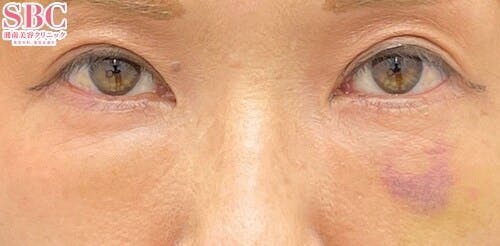 【50代女性・目元】アイバックリムーブ法、ナチュラル脂肪注射コンデンスリッチ、ナチュラル脂肪注射ナノリッチ_1week