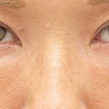 【50代女性・目元】アイバックリムーブ法、ナチュラル脂肪注射コンデンスリッチ、ナチュラル脂肪注射ナノリッチ_1week