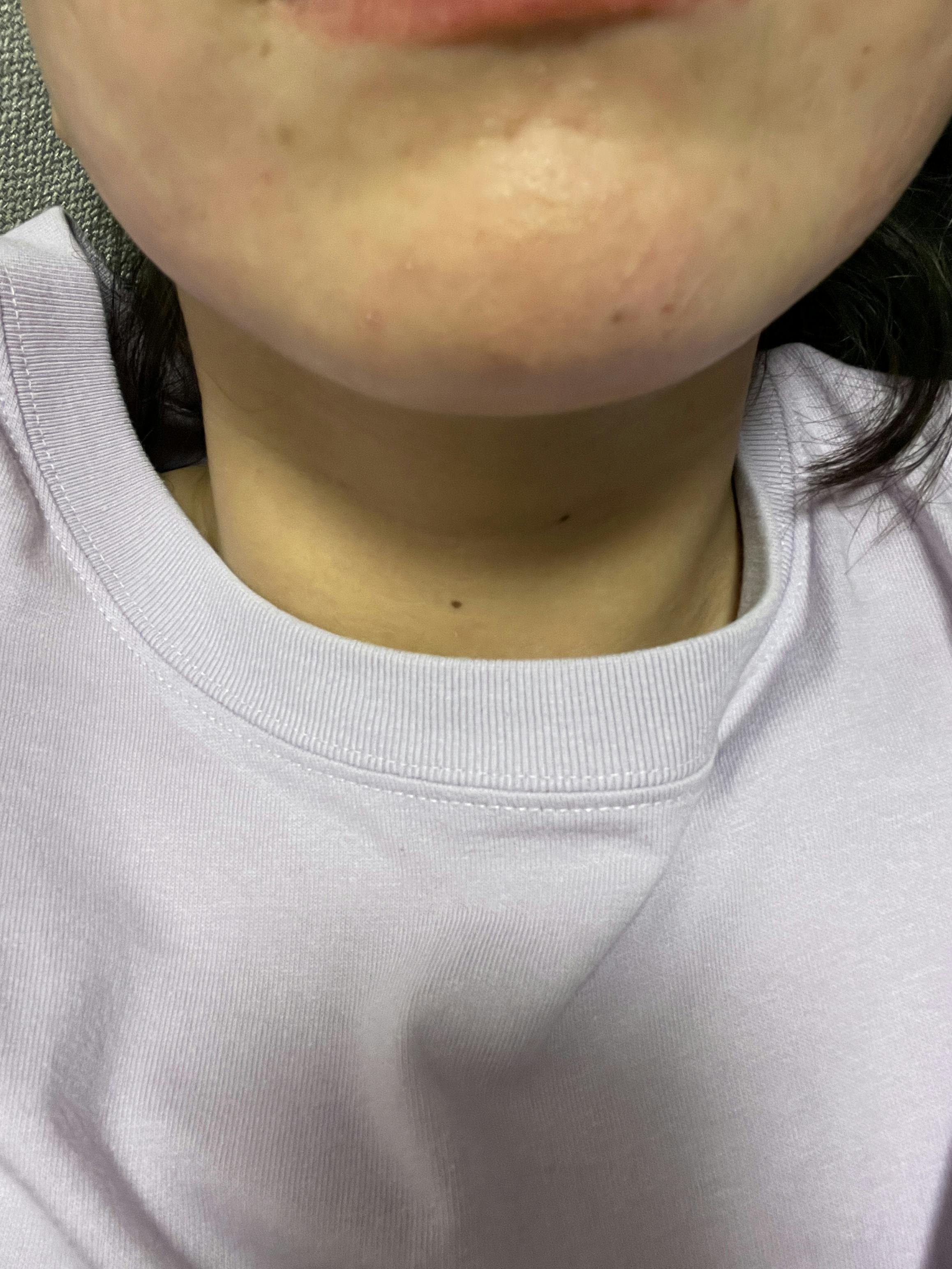 MILDIX SKIN CLINIC(ミルディス皮フ科 北千住院)でを受けたえりすけさんの写真