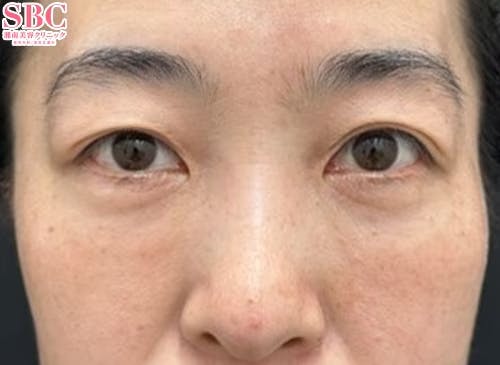 【女性・たるみ】目の下の切らないクマ・たるみ（ふくらみ）取り・ナチュラル脂肪注射コンデンスリッチ_after