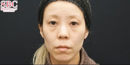 【女性・目元・顔】目の下の切らないクマ・たるみ（ふくらみ）取り、ナチュラル脂肪注射コンデンスリッチ、ナチュラル脂肪注射ナノリッチ、VOVリフト_before