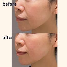 【女性・法令線】スーパーハイフRT_before_aftar