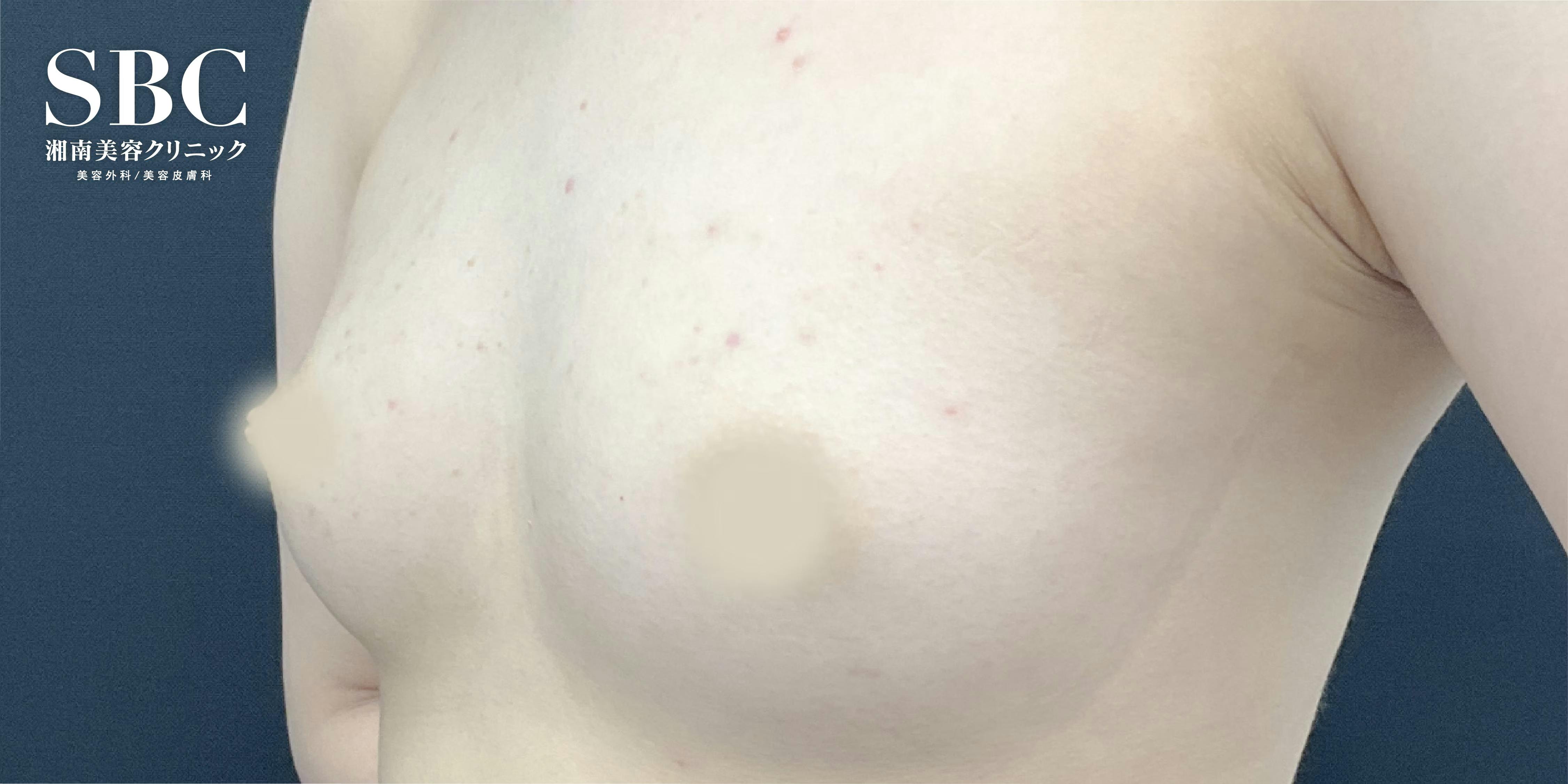 【女性・胸】コンデンスリッチ(脂肪注入豊胸)_before