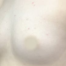 【女性・胸】コンデンスリッチ(脂肪注入豊胸)_before