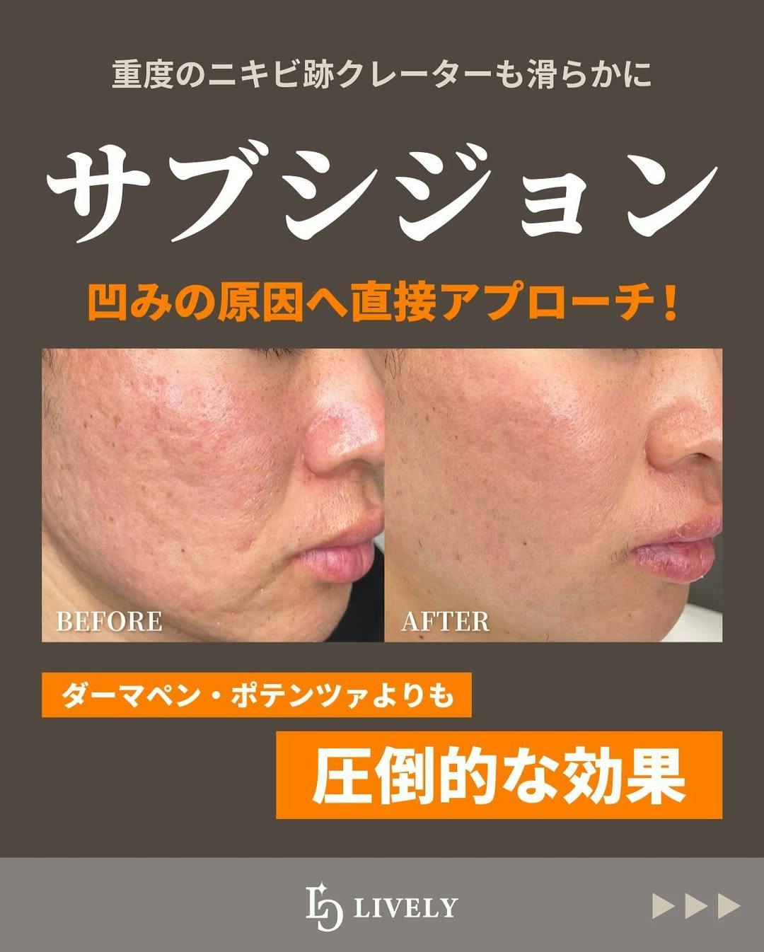 【男性・顔】サブシジョン_before_aftar