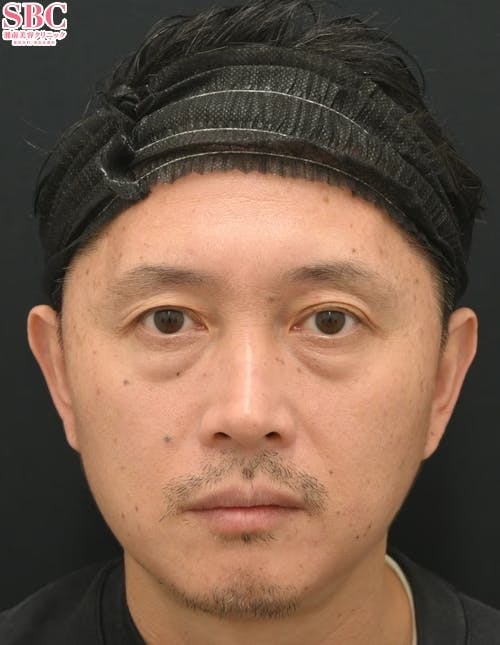 【50代男性・クマ】目の下の切らないクマ・たるみ（ふくらみ）取り ナチュラル脂肪注射コンデンスリッチ ナチュラル脂肪注射ナノリッチ_before