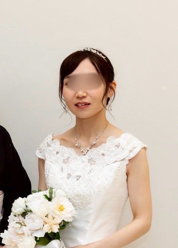 TCB東京中央美容外科 姫路院でボトックス注射・エラボトックス注射(小顔)・韓国製ボトックス・ボツリヌストキシン・ボトックス注射・ボトックス注射(顎)・目尻ボトックス注射・眉間ボトックス注射・目の下ボトックス注射・おでこ(額)ボトックス注射・バニーライン・鼻根ボトックス注射・韓国製ボトックス・ボツリヌストキシンを受けたrionさんの写真