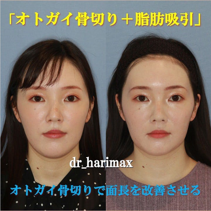 【女性・顎・頬】オトガイ骨切り・頬顎下脂肪吸引_before_aftar