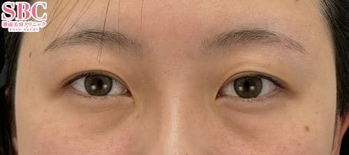 【20代女性・目元】クイックコスメティーク・ダブルNeo_before