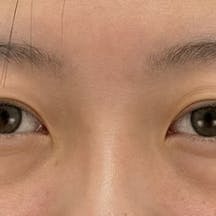 【20代女性・目元】クイックコスメティーク・ダブルNeo_before