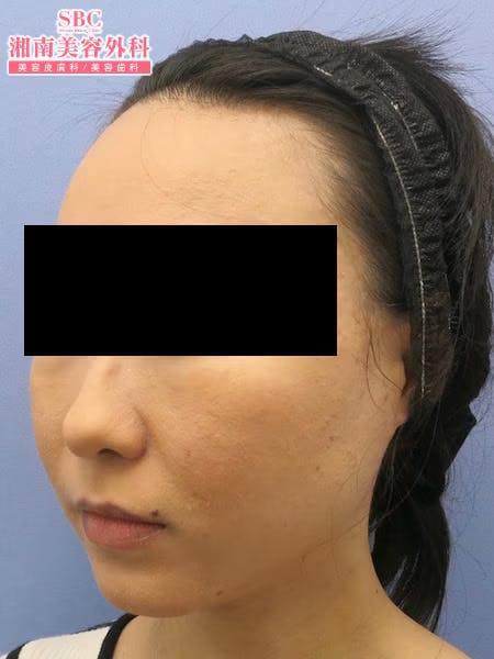 【女性・顔】根こそぎVASER脂肪吸引・ライポマティック脂肪吸引_aftar