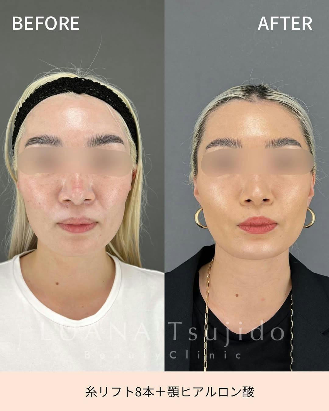 【女性・顔・顎】糸リフト・顎ヒアルロン酸_before_aftar