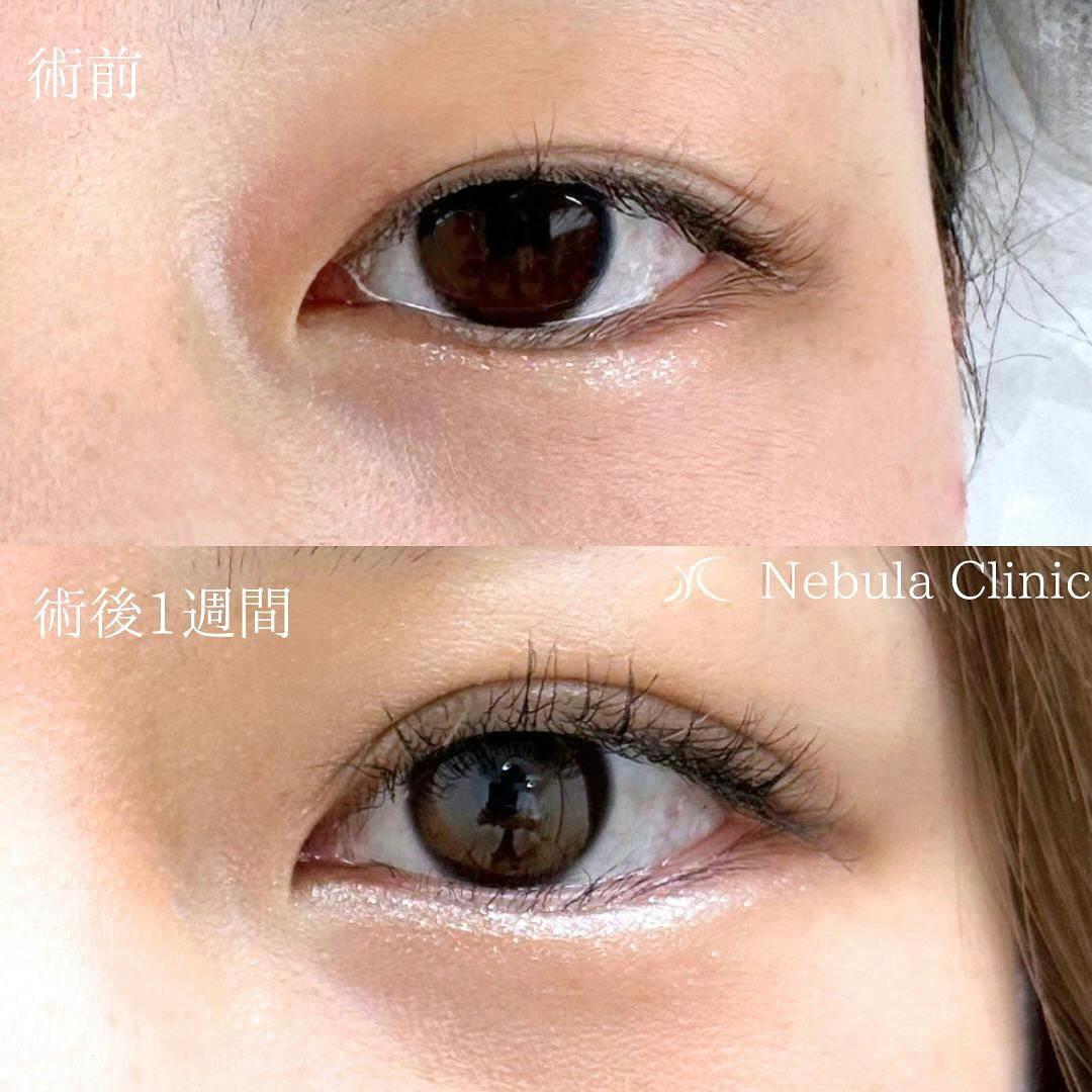 【女性・目元】二重埋没法_before_aftar