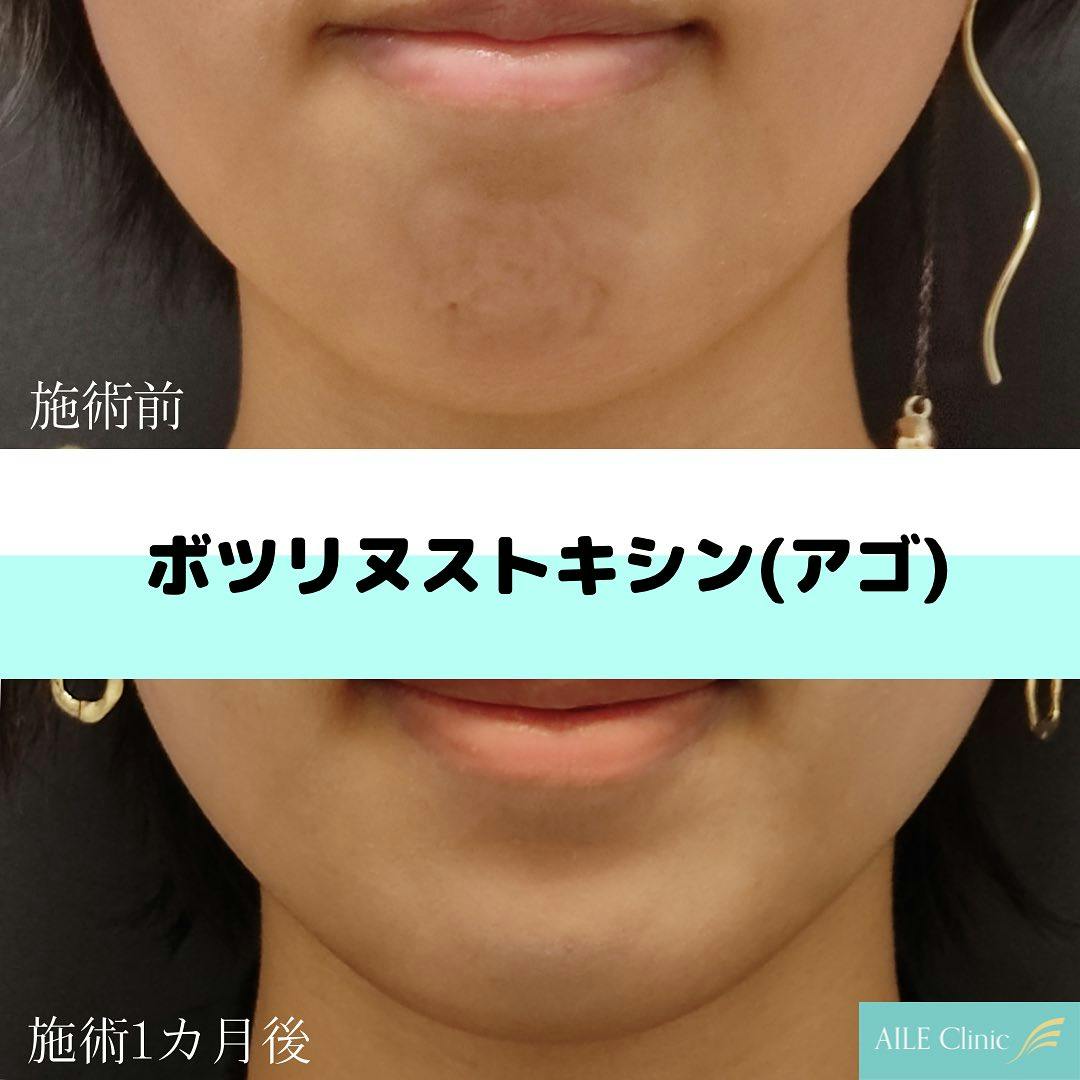 【女性・アゴ】ボツリヌストキシン注入_before_aftar
