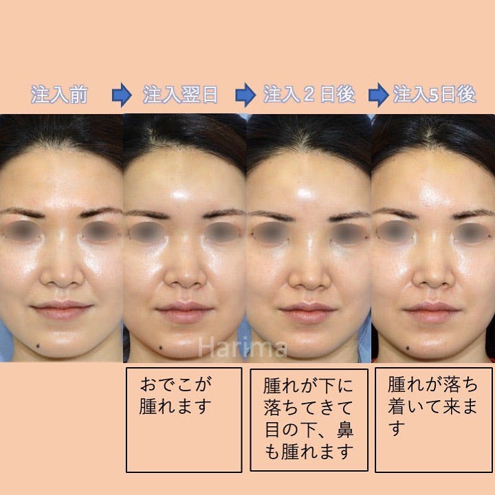 【女性・おでこ】ヒアルロン酸注入_before_aftar