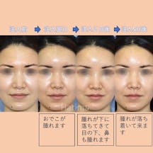 【女性・おでこ】ヒアルロン酸注入_before_aftar