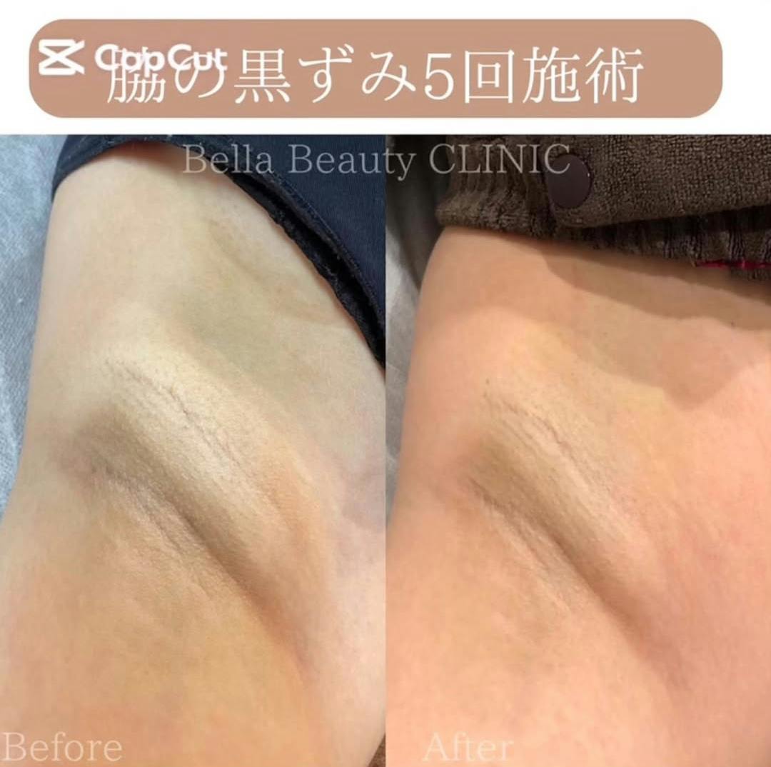 【女性・黒ずみ】ミラノリピール＋ピコトーニング_before_aftar