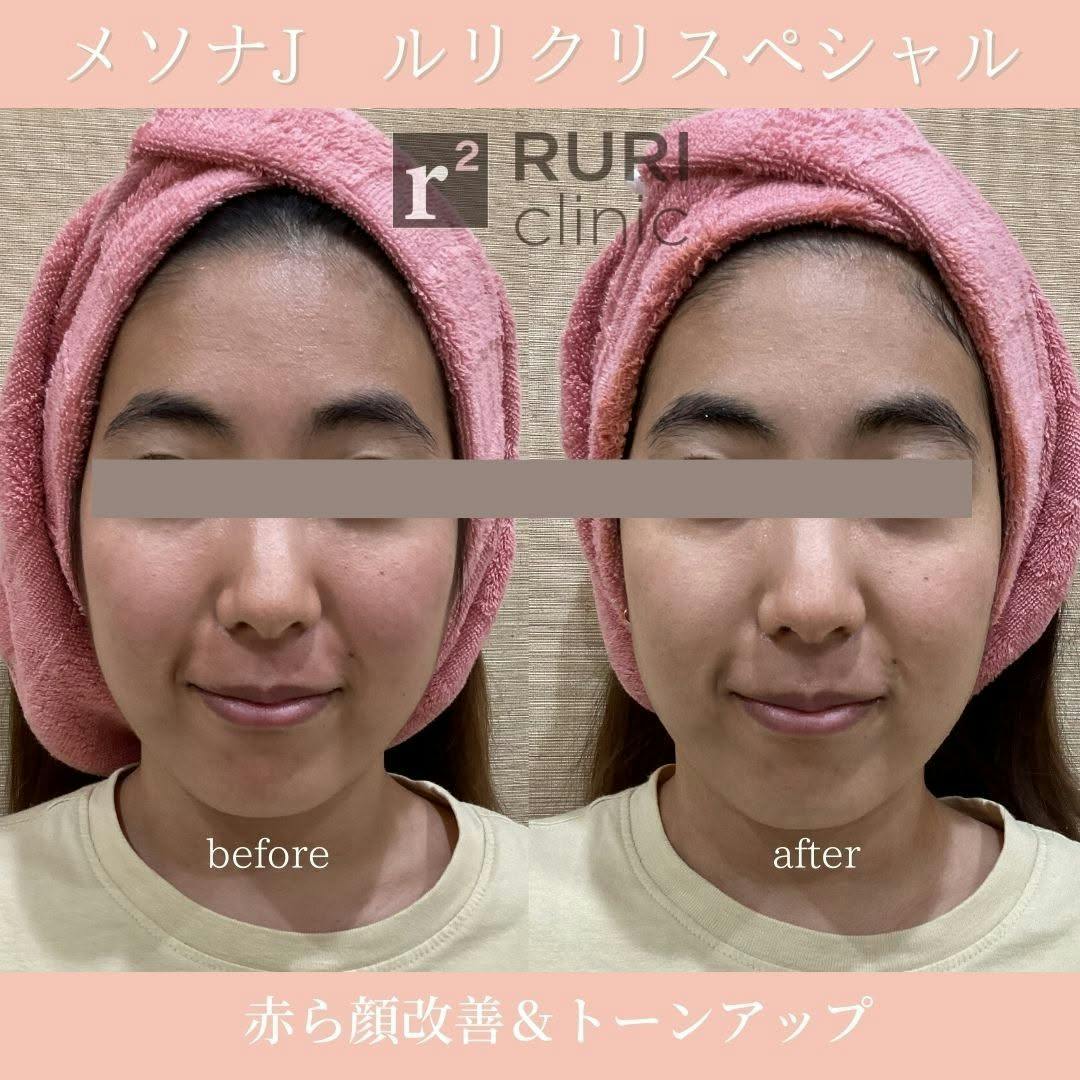 【女性・赤み】メソナJ_before_aftar