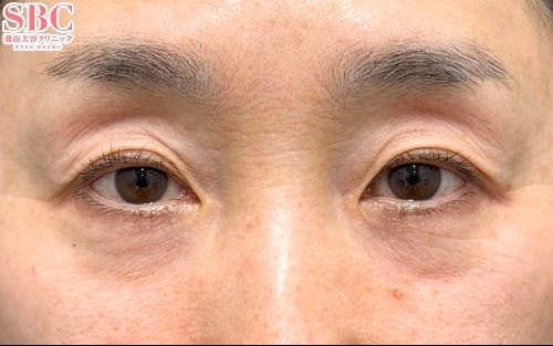 【女性・クマ】アイバックリムーブ法 ナチュラル脂肪注射コンデンスリッチ ナチュラル脂肪注射ナノリッチ_before