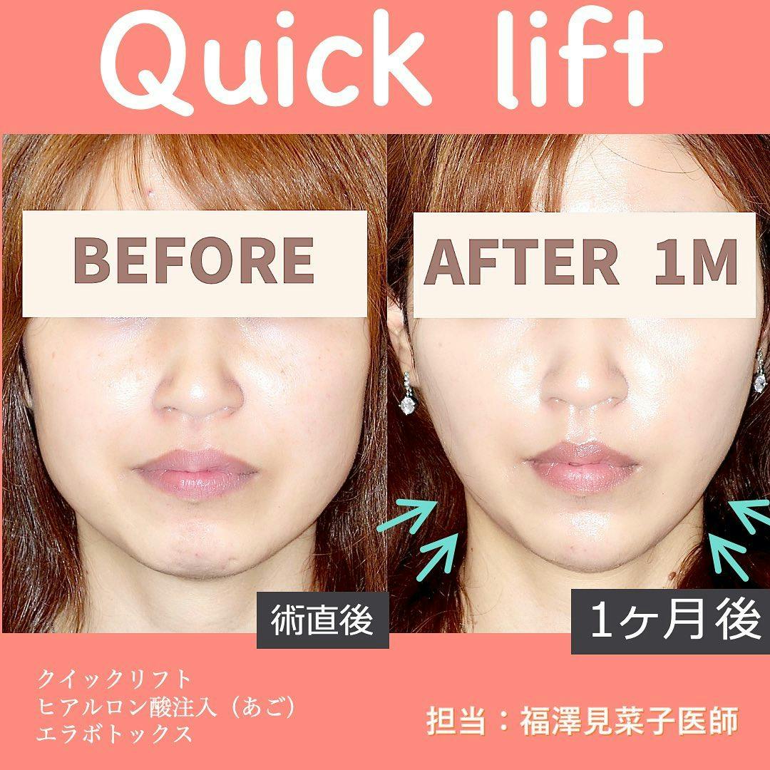 【女性・輪郭】クイックリフト、エラボトックス、ヒアルロン酸（顎・法令線）_before_aftar