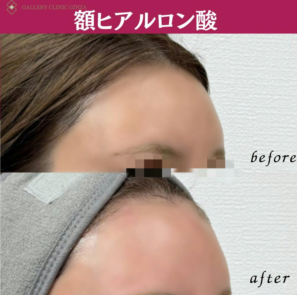 【女性・額】ヒアルロン酸(額)_before_aftar