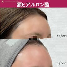【女性・額】ヒアルロン酸(額)_before_aftar