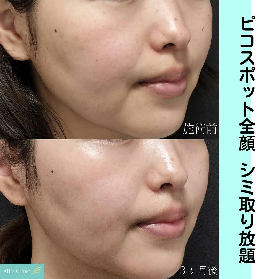 【女性・シミ】ピコスポット全顔_before_aftar