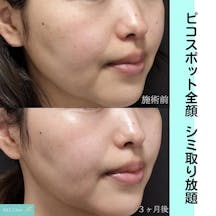 【女性・シミ】ピコスポット全顔_before_aftar