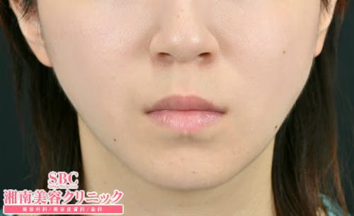 【女性・輪郭】顔の脂肪吸引_aftar