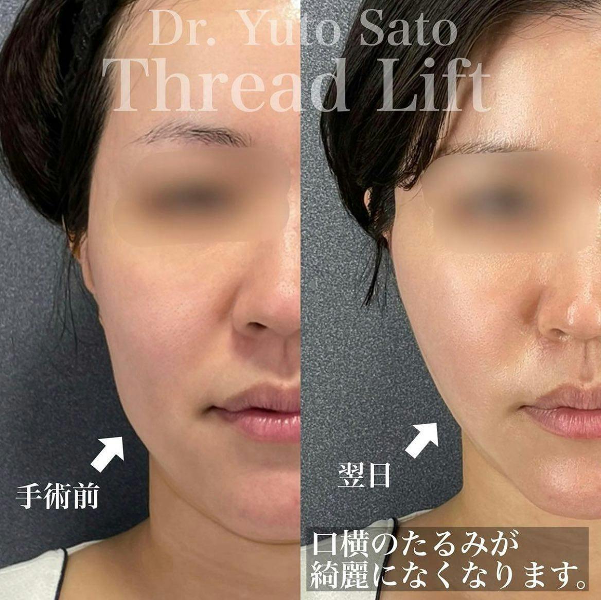 【女性・たるみ】糸リフト_before_aftar