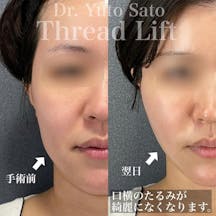 【女性・たるみ】糸リフト_before_aftar