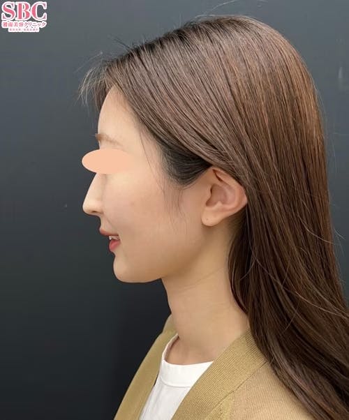 【20代女性・顔】根こそぎVASER脂肪吸引、シークレットリフト_after