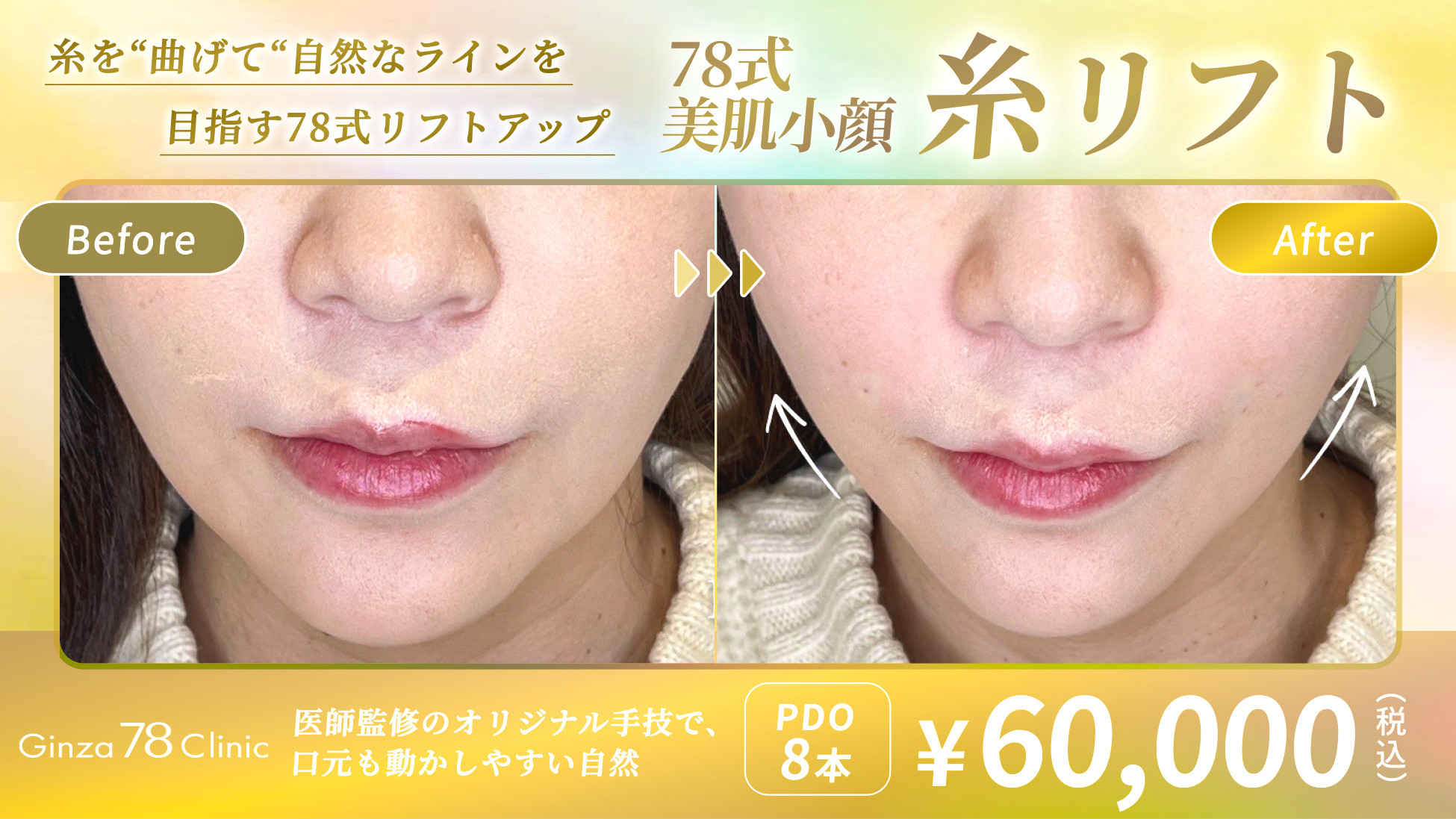 Ginza78Clinicの糸リフト症例_FV