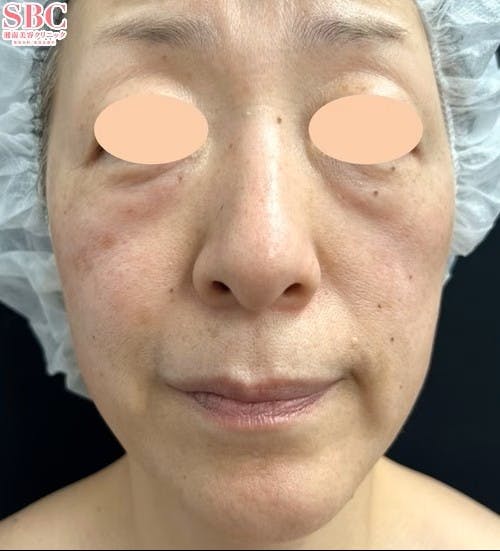 【50代女性・たるみ】目の下の切らないクマ・たるみ（ふくらみ）取り ナチュラル脂肪注射コンデンスリッチ_before