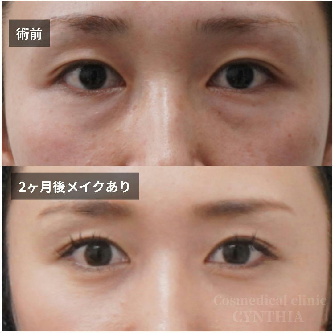 【30代女性・目元】経結膜脱脂術・眼窩脂肪注入_before_aftar