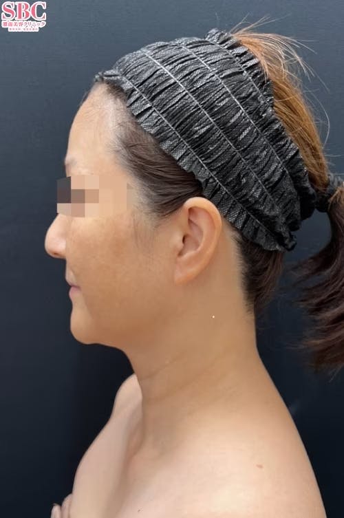 【女性・目元】Aquicell（アキーセル）脂肪吸引、根こそぎVASER脂肪吸引、エンブレイスRF、糸リフト_before