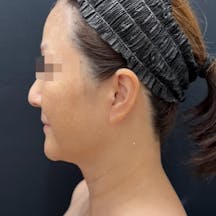 【女性・目元】Aquicell(アキーセル)脂肪吸引、根こそぎVASER脂肪吸引、エンブレイスRF、糸リフト_before